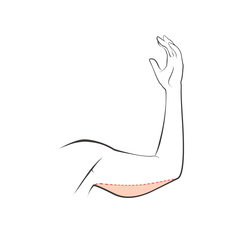Arm Lift