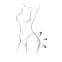 Butt Lifting & Shaping (BBL)