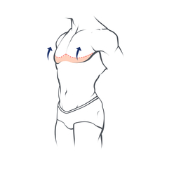 Gynecomasty