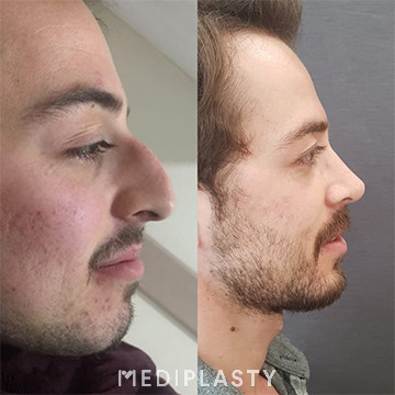 Nose Aesthetics