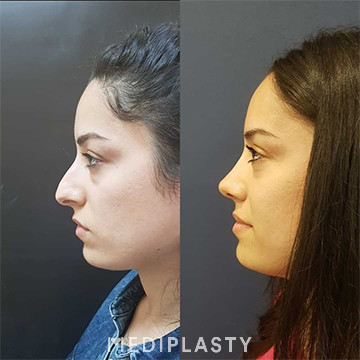 Nose Aesthetics
